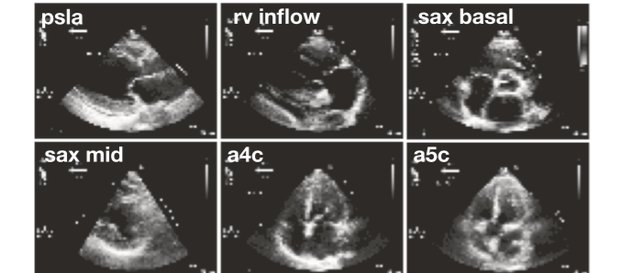 Six echocardiogram images showing different views of the heart.
